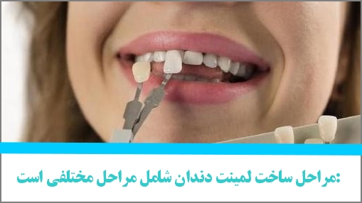 مراحل ساخت لمینت دندان شامل مراحل مختلفی است