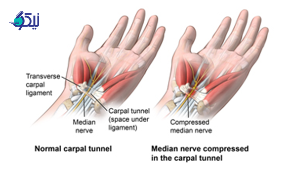 سندرم تونل کارپال