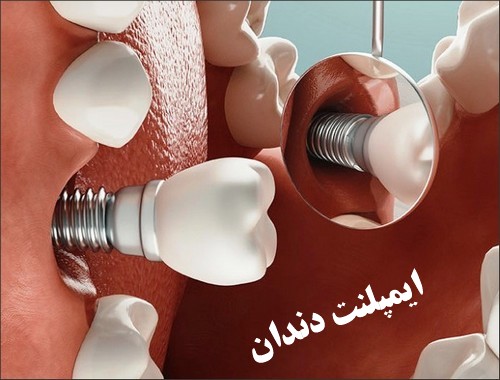 ایمپلنت اندوستئال رایج ترین نوع ایمپلنت دندان است +  شکست ایمپلنت دندانی
