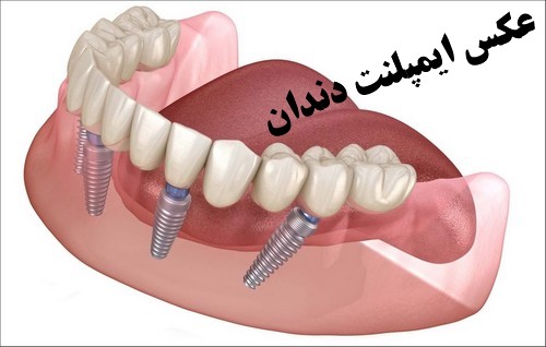 ایمپلنت اندوستئال رایج ترین نوع ایمپلنت دندان است +  شکست ایمپلنت دندانی