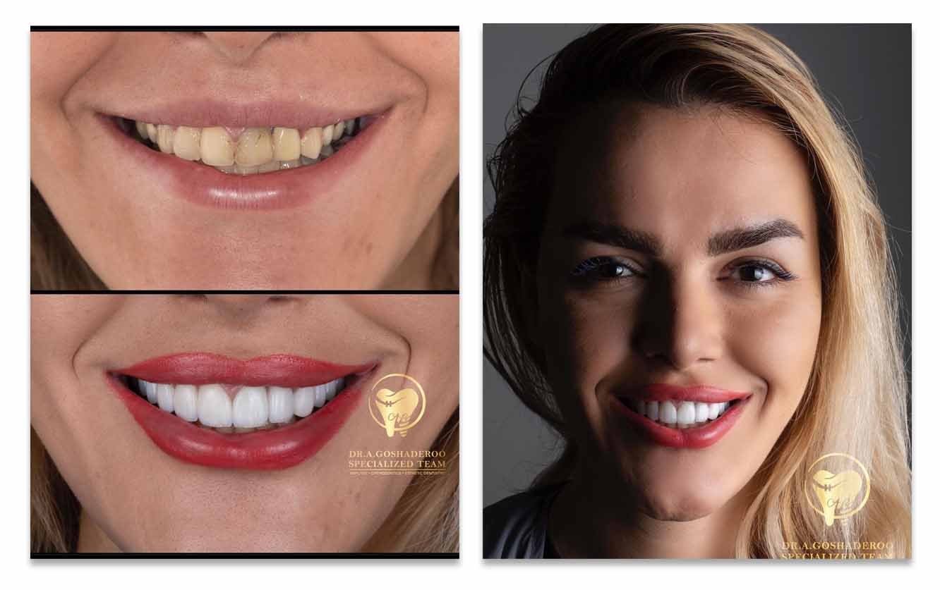 نمونه کار زیبایی دندان دکتر عزیز گشاده رو